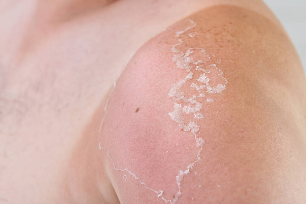 poparzona skóra na ciele mężczyzny. Koncepcja pielęgnacji skóry i ochrony przed promieniowaniem UV - Zdjęcie, obraz