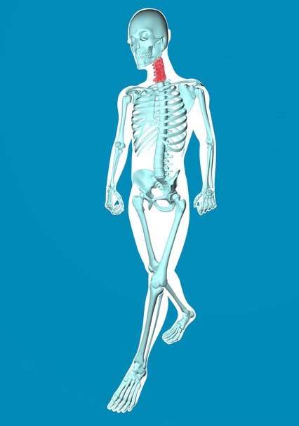 Kävelevä mies röntgenkuva kipua niskassa
 - Valokuva, kuva