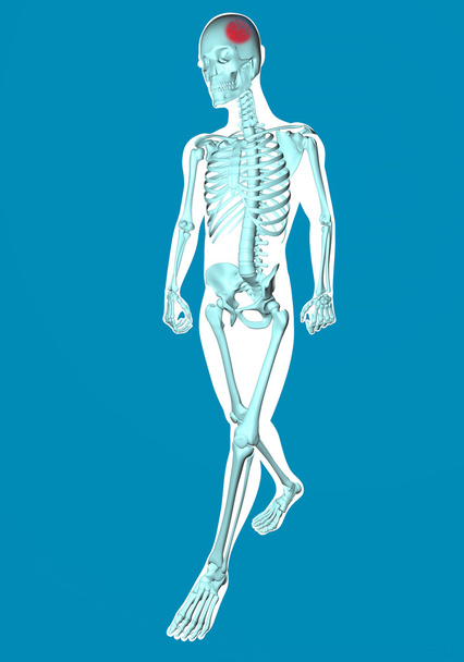 Kävelevä mies röntgenkuva kipua kallo
 - Valokuva, kuva