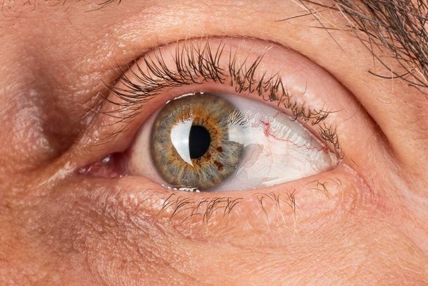 persona anziana assottigliamento degli occhi della cornea, distrofia corneale del cheratocono. - Foto, immagini