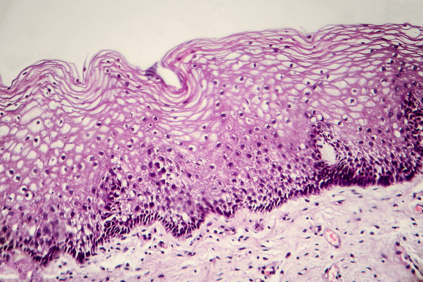 Cáncer de cuello uterino. Micrografía ligera de biopsia cervical. Foto bajo el microscopio. Enfoque selectivo - Foto, Imagen
