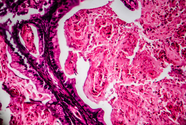 Cancer de l'ovaire, micrographie photonique, photo au microscope. La photo montre un fragment d'une tumeur cancéreuse dans l'ovaire féminin. Concentration sélective - Photo, image