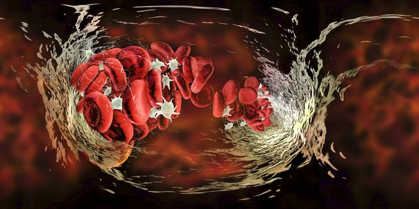 Caillot sanguin constitué de globules rouges, de plaquettes et de brins de protéines de fibrine. Vue panoramique de 360 degrés VR. Thrombus, illustration 3D - Photo, image