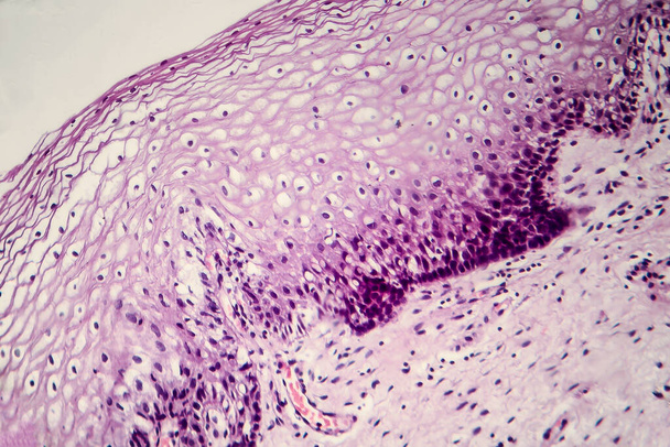 子宮頸部癌。子宮頸部生検の軽いマイクログラフ。顕微鏡下の写真。選択的焦点 - 写真・画像