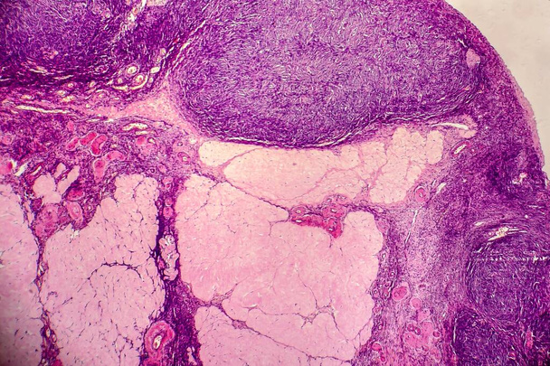 Cisti ovarica, microscopio a luce, foto al microscopio. La fotografia mostra un frammento della cisti nell'ovaio femminile. Focus selettivo - Foto, immagini