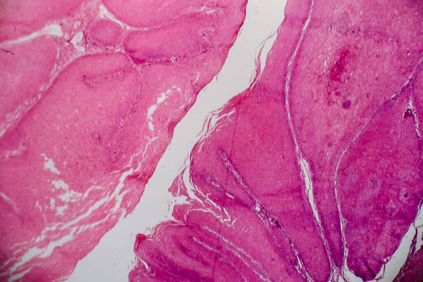 Condyloma acuminatum, tunnetaan myös genitaalialueen syyliä. Valomikrografi, valokuva mikroskoopilla - Valokuva, kuva