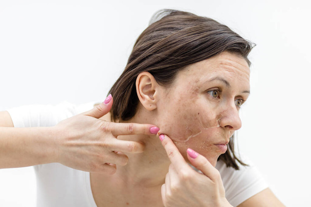 Photo of woman with acne problem squeezing pimple indoors. - Foto, Bild