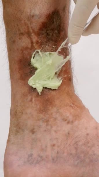 Wunde fleckige Bein der Person, die an Verstopfung von Venen, Geschwüren, Dermatitis, Ekzemen oder anderen Infektionskrankheiten der Dermatologie leiden. Vertikales Format. - Filmmaterial, Video