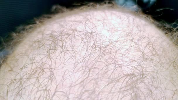 Macro di pelle umana pelosa. Concetto dermatologico. Crescita eccessiva dei capelli - Filmati, video