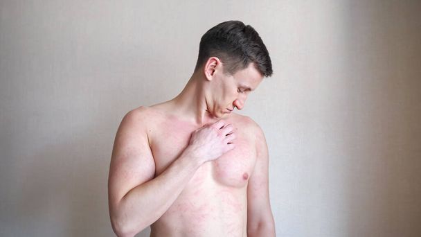 Järkyttynyt mies naarmuja rinta kärsii ärsyttävää kutinaa - Valokuva, kuva