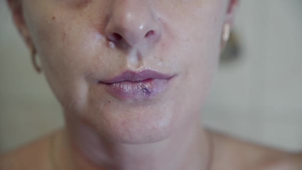 Dermatologische Krankheit, Herpes, auf den Lippen einer Frau. Virusinfektion, Blasenbildung. - Filmmaterial, Video