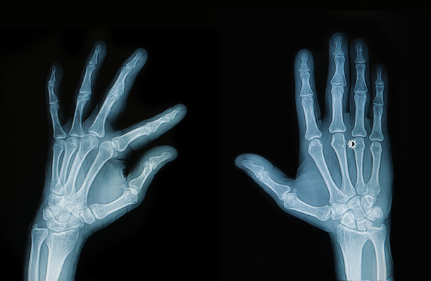 Mano y dedo de rayos X
 - Foto, imagen