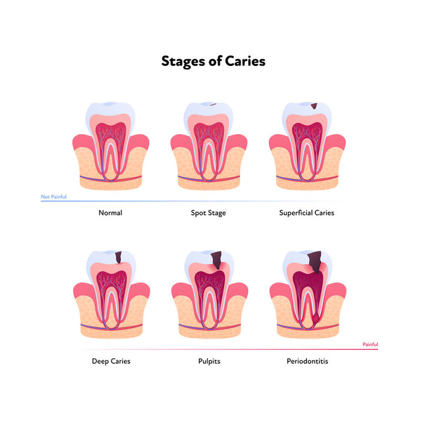 Anatomia zębów i wykres rozkładu. Ilustracja biomedyczna wektora. Przekrój. Etapy próchnicy zębów izolowane na białym tle. Projekt dla opieki zdrowotnej, stomatologii - Wektor, obraz