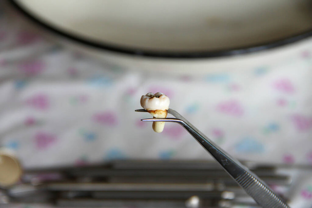 Extracted molar tooth in the tweezers - Photo, Image