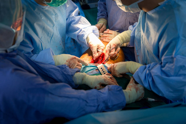 Shot of emergency and serious accident. Medical Team Performing Surgical Operation in Modern Operating Room. Medical team performing surgery in hospital. Group of surgeon at work in operation theater. - Photo, image