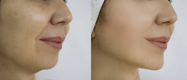 Kadın tedaviden önce ve sonra kırışıklıklarla karşılaşır - Fotoğraf, Görsel