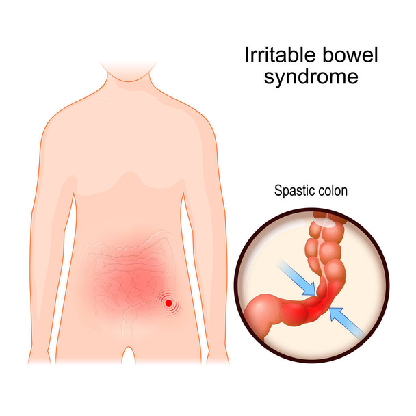 Sindrome dell'intestino irritabile. IBS o colite mucosa è un disturbo gastrointestinale funzionale. Corpo umano con aree di dolore addominale e primo piano del colon spastico. - Vettoriali, immagini