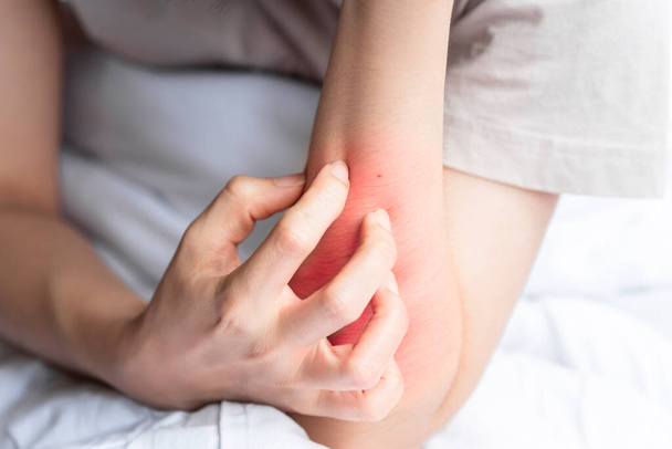 Una donna sta graffiando un braccio rosso blister a causa di un'intolleranza del corpo estraneo o un morso di insetto. - Foto, immagini