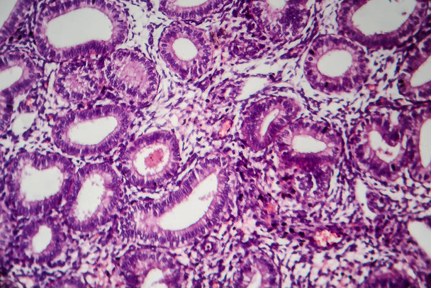Endometrioosi, häiriö, jossa kohdun limakalvon solujen kaltaiset solut kasvavat kohdun ulkopuolella. Valomikrografi, valokuva mikroskoopilla - Valokuva, kuva