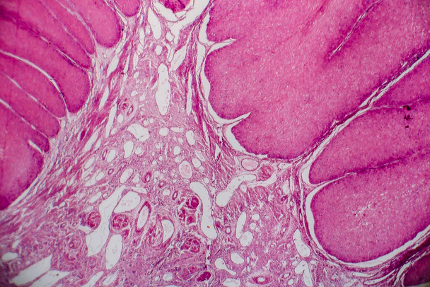 Condyloma acuminatum, também conhecido como verrugas genitais. Micrografia de luz, foto sob microscópio - Foto, Imagem