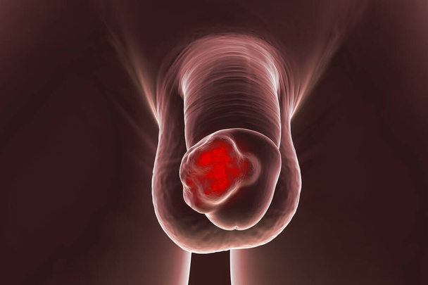 Penile cancer, 3D illustration showing malignant tumor on the human penis - Fotoğraf, Görsel