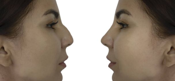 κορίτσι καμπούρα μύτη πριν και μετά τη θεραπεία - Φωτογραφία, εικόνα