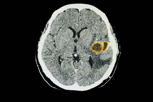 КТ мозга пациента с большими абсцессами мозга в левой височной доле. - Фото, изображение