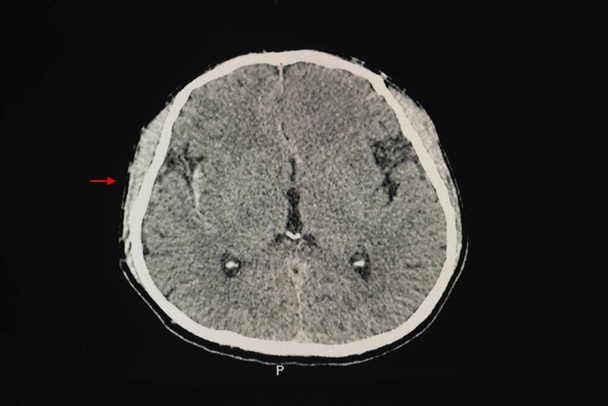 Tomografia computadorizada do cérebro de um paciente com hemorragia subural em cisterna sinlviana direita, sulcos parietais e corticais direitos e hemorragia peridural apenas falx e ambos cerebelo tentorial. - Foto, Imagem