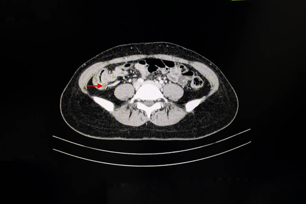 TC Scansione di un addome di un paziente con dolore addominale che mostra appendice gonfia suggerendo la diagnosi di appendicite acuta. - Foto, immagini
