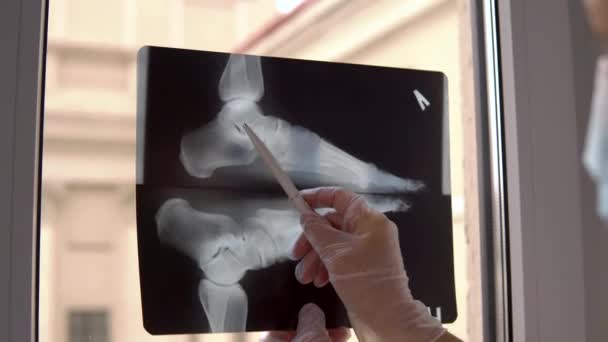 Doctor examina película de rayos X de pie roto - Metraje, vídeo