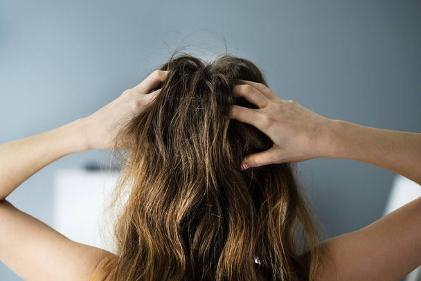 Itching Dry Head Scalp And Long Hair With Dandruff - Valokuva, kuva