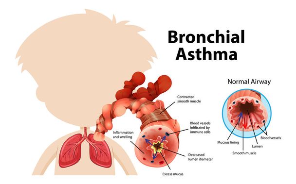 Bronchiális asztma diagram normál légúti és asztmás légúti illusztrációval - Vektor, kép