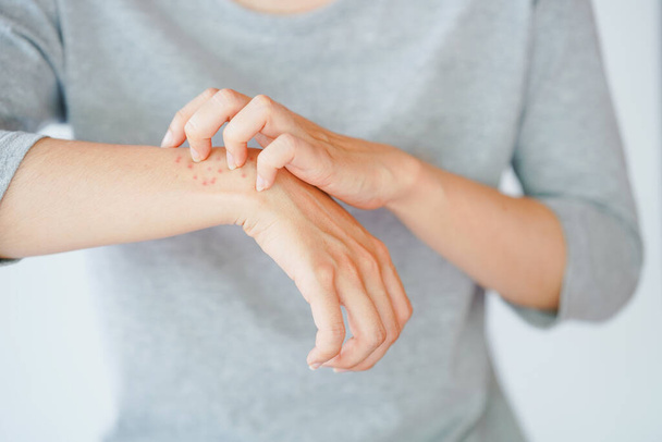 Una donna che si gratta il braccio, sperimenta una reazione allergica o viene punto da un insetto. Concetto di malattia della pelle. - Foto, immagini