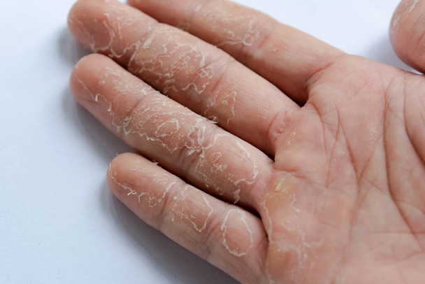 Peeling skin on hand and fingers. Desquamation - Foto, afbeelding