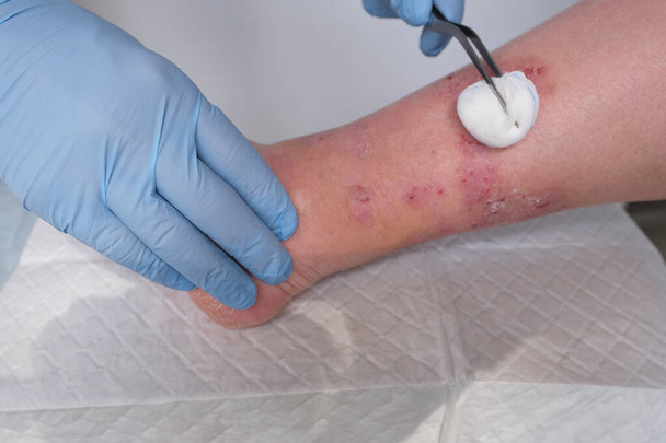 close-up of human shin, doctor treats numerous wounds on leg of an adult female patient, redness, scarring, sores from scratching, concept of medical care, self-harm to skin - Φωτογραφία, εικόνα