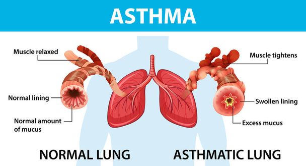 Диаграмма астмы с нормальной иллюстрацией легких и астматических легких - Вектор,изображение