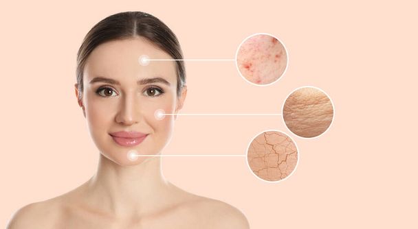 Young woman with skin problem on beige background - Foto, imagen