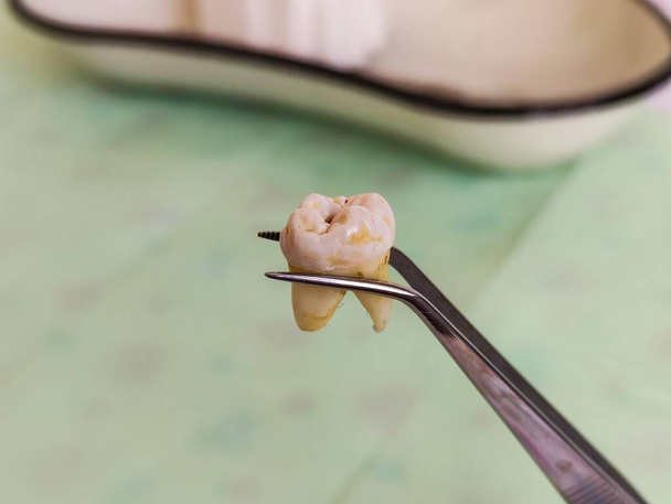 Витягнутий молярний зуб у пінцеті на тлі зубного лотка, крупним планом
 - Фото, зображення