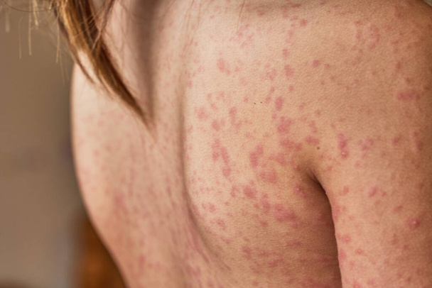 Hastanın vücudunda alerjik kızarıklık var. 5 yaşında bir kız..  - Fotoğraf, Görsel