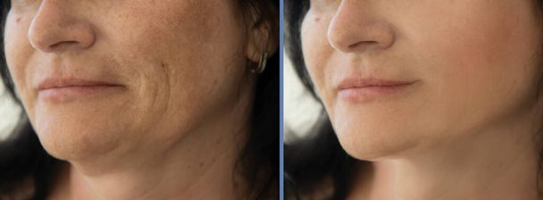 治療前と治療後の女性の顔のしわ - 写真・画像