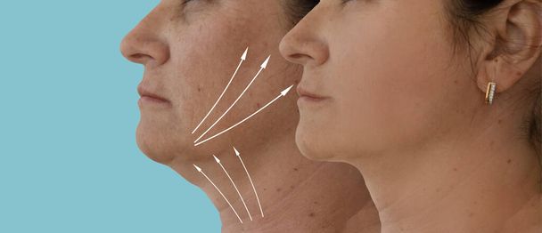 γυναίκα αντιμετωπίζουν ρυτίδες πριν και μετά τη θεραπεία - Φωτογραφία, εικόνα