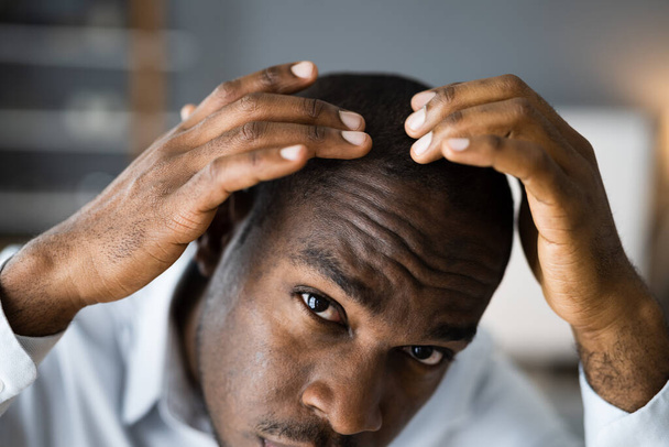 Young African Men Hair Loss. Watching Hairloss - Foto, afbeelding