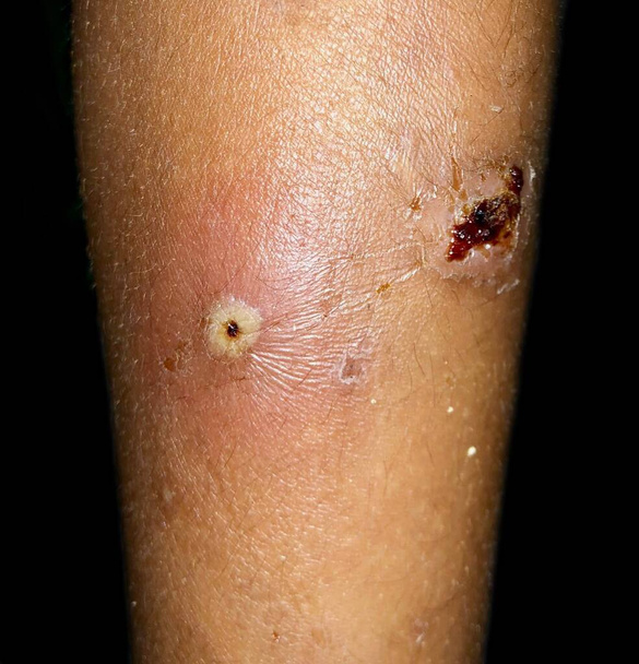 Furunkel oder Staphylokokken-Infektion im Bein eines asiatischen Kindes. Auch Siedepunkt genannt. Schmerzhafte Hautveränderungen. - Foto, Bild