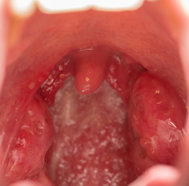 Vista a bocca aperta delle tonsille
 - Foto, immagini