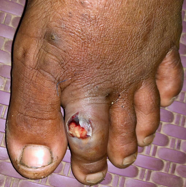 Abcès avec cellulite environnante ou staphylocoque, infection cutanée streptococcique à l'orteil d'un patient asiatique de sexe masculin birman. - Photo, image