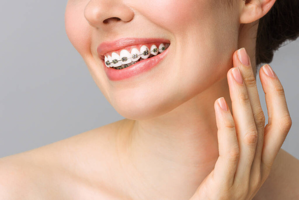 歯列矯正歯科治療の概念.女性の健康的な笑顔を閉じます。歯にセラミックと金属製のブラケットを閉じます。美しい女性の笑顔とブレース. - 写真・画像