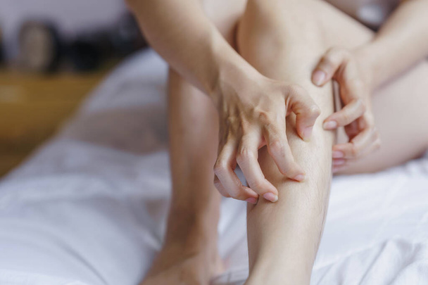 Рука жінки подряпає ногу в ліжку через алергічну реакцію
. - Фото, зображення