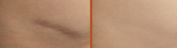 litteken op de huid voor en na de behandeling - Foto, afbeelding