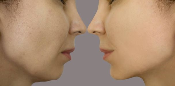  морщины лица женщины до и после лечения - Фото, изображение