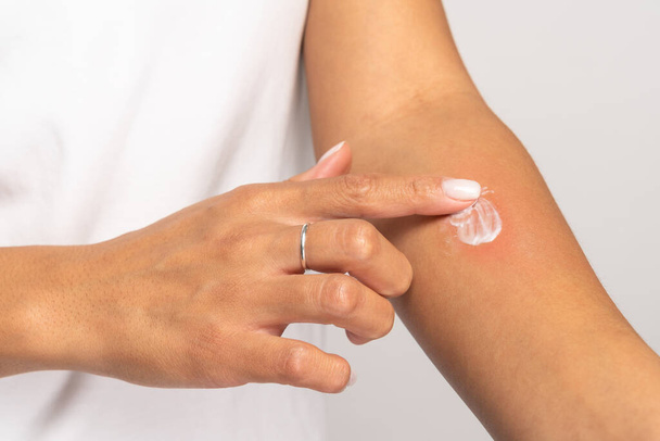Vrouwelijke aanbrengen crème op de deining huid na insectenbeten, geïsoleerd op grijze studio achtergrond. Allergie. - Foto, afbeelding